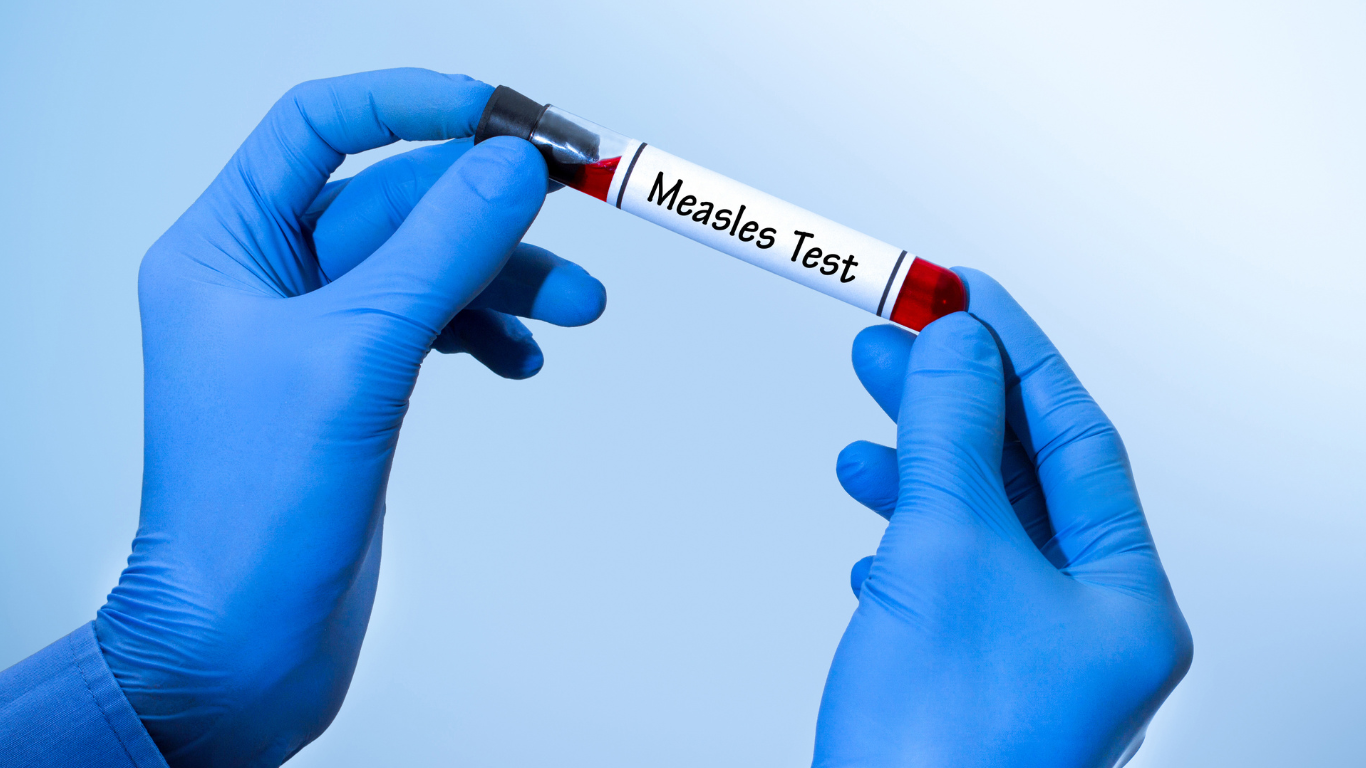 Tri slučaja malih boginja potvrđena u okruzima Broward i Miami-Dade